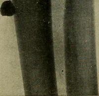 An illustration from The Roentgen rays in medicine and surgery as an aid in diagnosis and as a therapeutic agent : designed for the use of practitioners and students (1901)