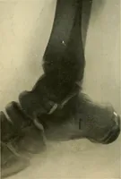 An illustration from The Roentgen rays in medicine and surgery as an aid in diagnosis and as a therapeutic agent : designed for the use of practitioners and students (1901)