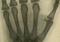 An illustration from The Roentgen rays in medicine and surgery as an aid in diagnosis and as a therapeutic agent : designed for the use of practitioners and students (1901)