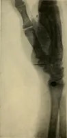 An illustration from The Roentgen rays in medicine and surgery as an aid in diagnosis and as a therapeutic agent : designed for the use of practitioners and students (1901)