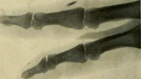 An illustration from The Roentgen rays in medicine and surgery as an aid in diagnosis and as a therapeutic agent : designed for the use of practitioners and students (1901)