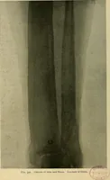 An illustration from The Roentgen rays in medicine and surgery as an aid in diagnosis and as a therapeutic agent : designed for the use of practitioners and students (1901)