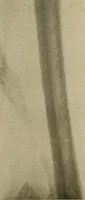 An illustration from The Roentgen rays in medicine and surgery as an aid in diagnosis and as a therapeutic agent : designed for the use of practitioners and students (1901)