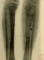 An illustration from The Roentgen rays in medicine and surgery as an aid in diagnosis and as a therapeutic agent : designed for the use of practitioners and students (1901)