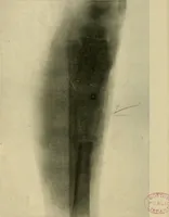 An illustration from The Roentgen rays in medicine and surgery as an aid in diagnosis and as a therapeutic agent : designed for the use of practitioners and students (1901)