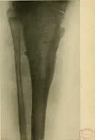 An illustration from The Roentgen rays in medicine and surgery as an aid in diagnosis and as a therapeutic agent : designed for the use of practitioners and students (1901)