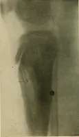 An illustration from The Roentgen rays in medicine and surgery as an aid in diagnosis and as a therapeutic agent : designed for the use of practitioners and students (1901)