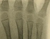 An illustration from The Roentgen rays in medicine and surgery as an aid in diagnosis and as a therapeutic agent : designed for the use of practitioners and students (1901)