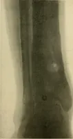 An illustration from The Roentgen rays in medicine and surgery as an aid in diagnosis and as a therapeutic agent : designed for the use of practitioners and students (1901)