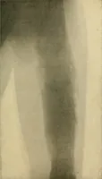 An illustration from The Roentgen rays in medicine and surgery as an aid in diagnosis and as a therapeutic agent : designed for the use of practitioners and students (1901)