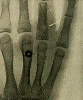 An illustration from The Roentgen rays in medicine and surgery as an aid in diagnosis and as a therapeutic agent : designed for the use of practitioners and students (1901)