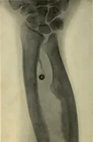 An illustration from The Roentgen rays in medicine and surgery as an aid in diagnosis and as a therapeutic agent : designed for the use of practitioners and students (1901)