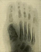 An illustration from The Roentgen rays in medicine and surgery as an aid in diagnosis and as a therapeutic agent : designed for the use of practitioners and students (1901)