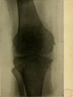 An illustration from The Roentgen rays in medicine and surgery as an aid in diagnosis and as a therapeutic agent : designed for the use of practitioners and students (1901)