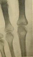 An illustration from The Roentgen rays in medicine and surgery as an aid in diagnosis and as a therapeutic agent : designed for the use of practitioners and students (1901)