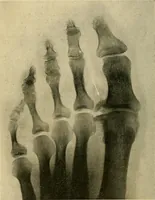 An illustration from The Roentgen rays in medicine and surgery as an aid in diagnosis and as a therapeutic agent : designed for the use of practitioners and students (1901)