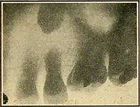 An illustration from The Roentgen rays in medicine and surgery as an aid in diagnosis and as a therapeutic agent : designed for the use of practitioners and students (1901)