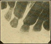 An illustration from The Roentgen rays in medicine and surgery as an aid in diagnosis and as a therapeutic agent : designed for the use of practitioners and students (1901)