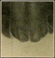An illustration from The Roentgen rays in medicine and surgery as an aid in diagnosis and as a therapeutic agent : designed for the use of practitioners and students (1901)