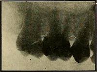 An illustration from The Roentgen rays in medicine and surgery as an aid in diagnosis and as a therapeutic agent : designed for the use of practitioners and students (1901)