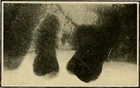 An illustration from The Roentgen rays in medicine and surgery as an aid in diagnosis and as a therapeutic agent : designed for the use of practitioners and students (1901)