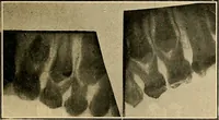 An illustration from The Roentgen rays in medicine and surgery as an aid in diagnosis and as a therapeutic agent : designed for the use of practitioners and students (1901)