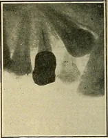 An illustration from The Roentgen rays in medicine and surgery as an aid in diagnosis and as a therapeutic agent : designed for the use of practitioners and students (1901)