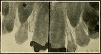 An illustration from The Roentgen rays in medicine and surgery as an aid in diagnosis and as a therapeutic agent : designed for the use of practitioners and students (1901)
