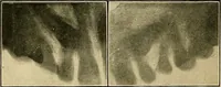 An illustration from The Roentgen rays in medicine and surgery as an aid in diagnosis and as a therapeutic agent : designed for the use of practitioners and students (1901)