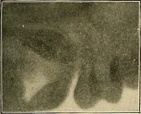 An illustration from The Roentgen rays in medicine and surgery as an aid in diagnosis and as a therapeutic agent : designed for the use of practitioners and students (1901)