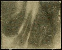 An illustration from The Roentgen rays in medicine and surgery as an aid in diagnosis and as a therapeutic agent : designed for the use of practitioners and students (1901)