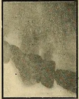 An illustration from The Roentgen rays in medicine and surgery as an aid in diagnosis and as a therapeutic agent : designed for the use of practitioners and students (1901)
