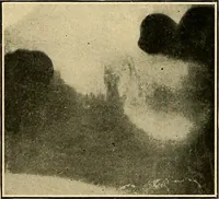 An illustration from The Roentgen rays in medicine and surgery as an aid in diagnosis and as a therapeutic agent : designed for the use of practitioners and students (1901)