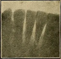 An illustration from The Roentgen rays in medicine and surgery as an aid in diagnosis and as a therapeutic agent : designed for the use of practitioners and students (1901)