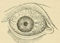 An illustration from The student's guide to diseases of the eye (1887)