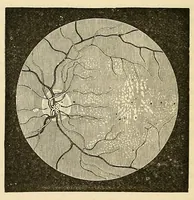 Picture 9 of 17 from The student's guide to diseases of the eye (1887), leaf 238