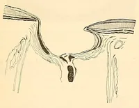 An illustration from The student's guide to diseases of the eye (1887)