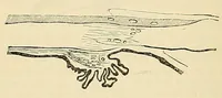 An illustration from The student's guide to diseases of the eye (1887)