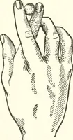 An illustration from Suggestion and psychotherapy (1912)