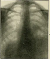 An illustration from Surgery of the lung (1913)