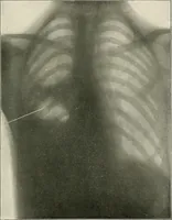An illustration from Surgery of the lung (1913)