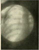An illustration from Surgery of the lung (1913)