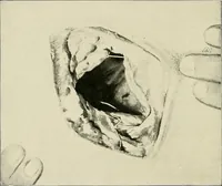 An illustration from Surgery of the lung (1913)