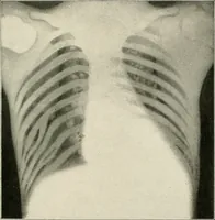 An illustration from Surgery of the lung (1913)