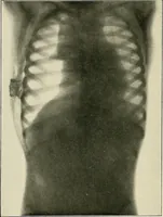 An illustration from Surgery of the lung (1913)