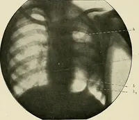 An illustration from Surgery of the lung (1913)
