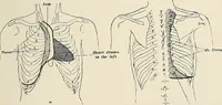 An illustration from Surgery of the lung (1913)