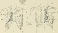 An illustration from Surgery of the lung (1913)