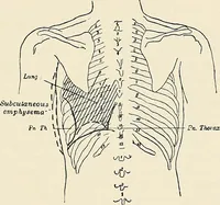 An illustration from Surgery of the lung (1913)