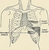 An illustration from Surgery of the lung (1913)